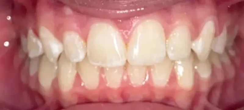 Dentes alinhados depois do tratamento ortodôntico