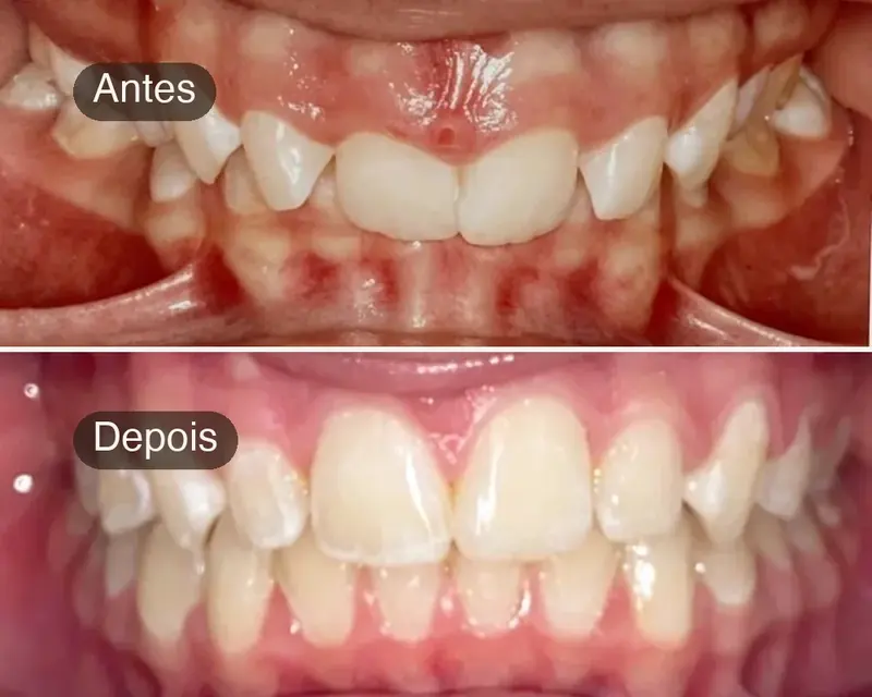 Antes e depois de dentes apinhados alinhados com ortodontia