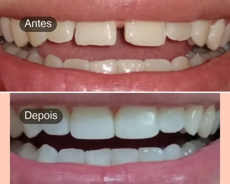 Antes e depois do fechamento de espaço entre os dentes da frente